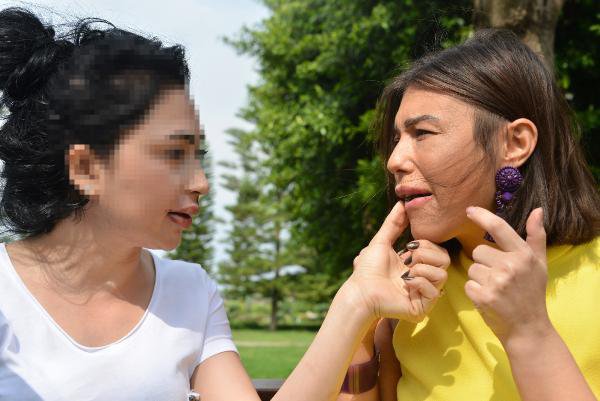 Dudakları Şişiren Sahte Estetikçiye 5 Yıl Hapis İstendi